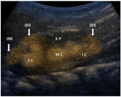 Intrarenal Reflux in the Light of Contrast-Enhanced Voiding Urosonography